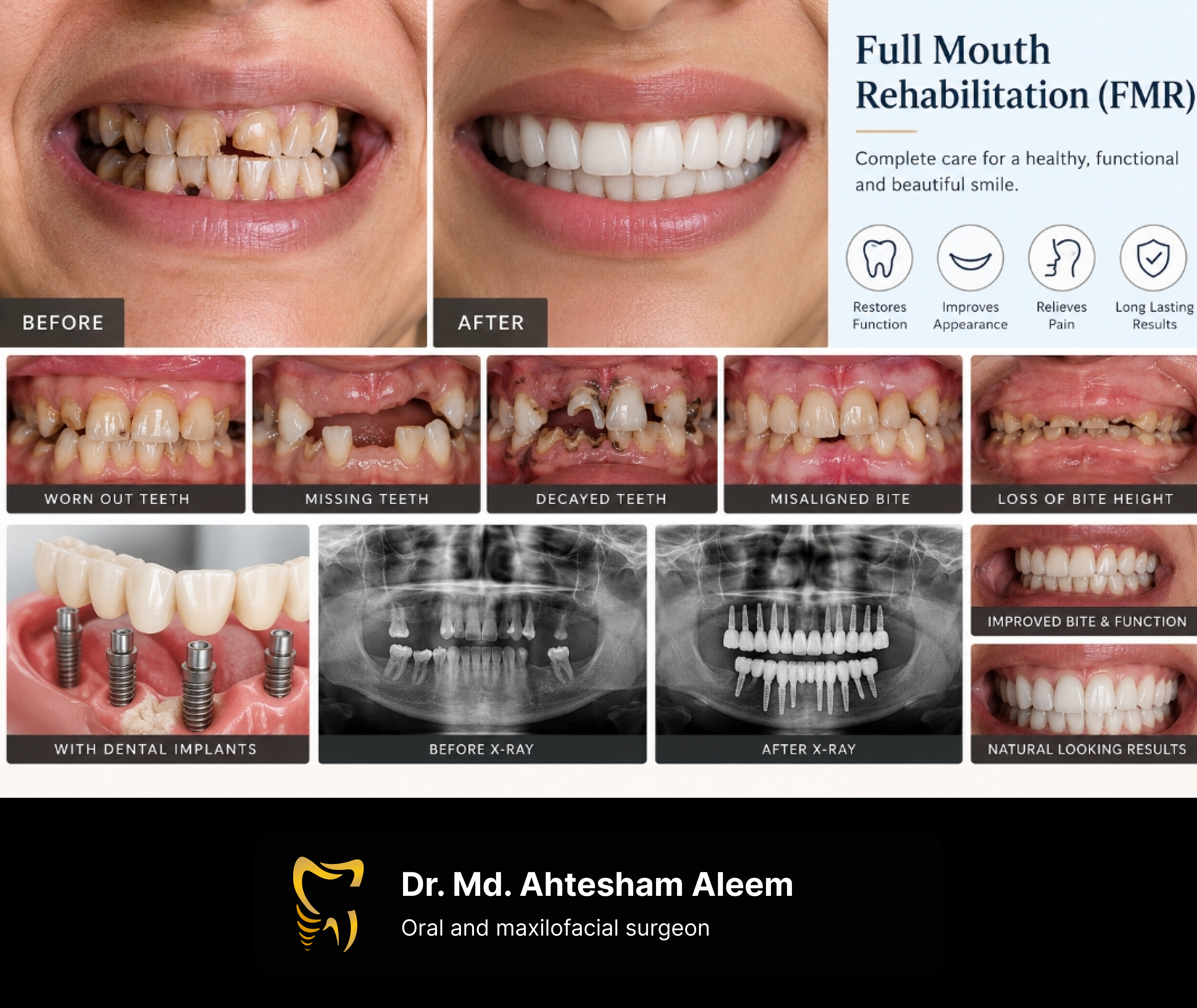 Full Mouth Rehabilitation with Dental Implants Image 1